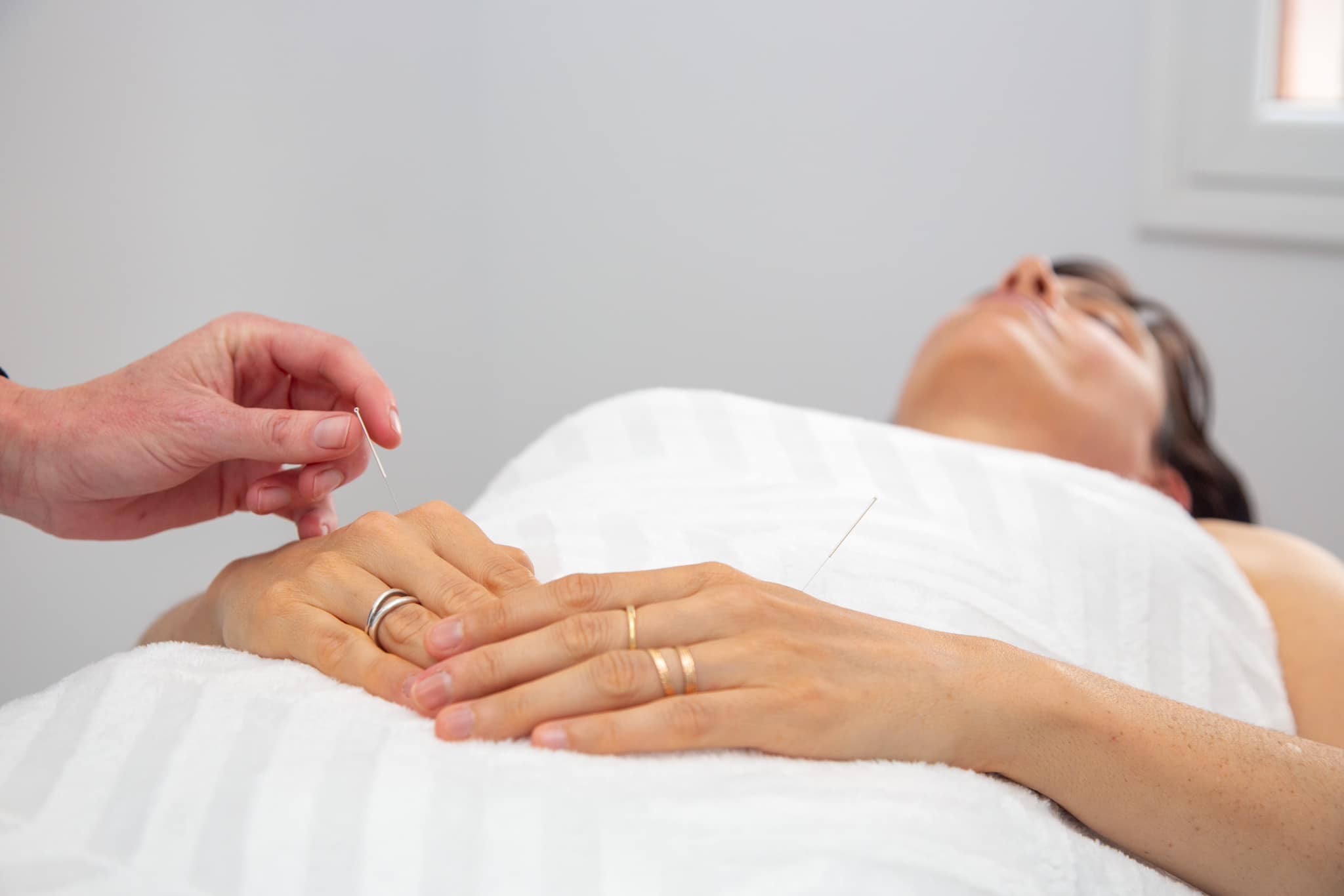 Photo of woman receiving accupuncture and being relaxed